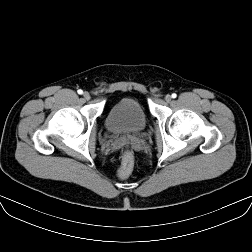 Bilateral accessory renal arteries with mild pelvi-ureteric junction (PUJ) obstruction (Radiopaedia 66357-75596 A 72).jpg