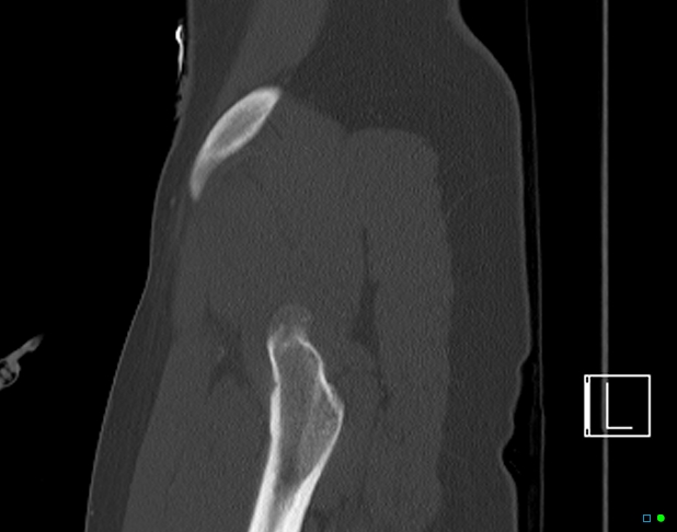 File:Bilateral acetabular fractures (Radiopaedia 79272-92308 Sagittal bone window 10).jpg