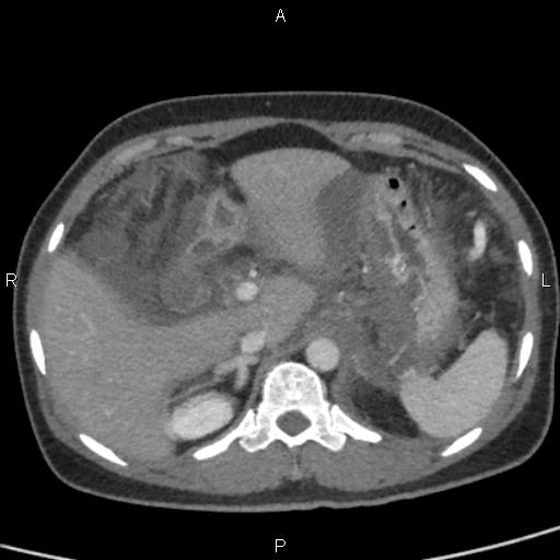 Bilateral adrenal gland hyperenhancement in pancreatitis (Radiopaedia 86642-102753 E 25).jpg