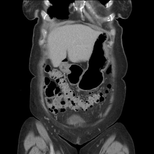 Bilateral adrenal granulocytic sarcomas (chloromas) (Radiopaedia 78375-91007 B 24).jpg