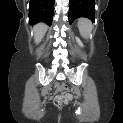 Bilateral adrenal granulocytic sarcomas (chloromas) (Radiopaedia 78375-91007 B 72).jpg