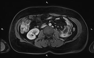 Bilateral adrenal myelolipoma (Radiopaedia 63058-71537 G 59).jpg