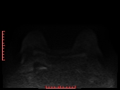 File:Bilateral breast implant rupture (Radiopaedia 24761-25027 DWI 10).jpg