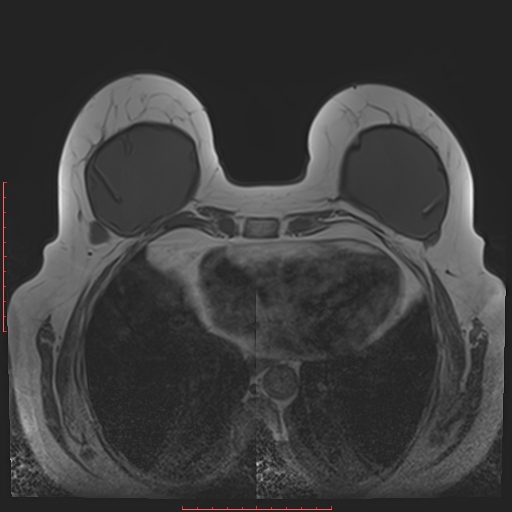 File:Bilateral breast implant rupture (Radiopaedia 24761-25027 T1 26).jpg