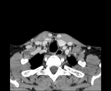 Bilateral carotid body tumors (Radiopaedia 61841-69870 Axial Post contrast 103).jpg