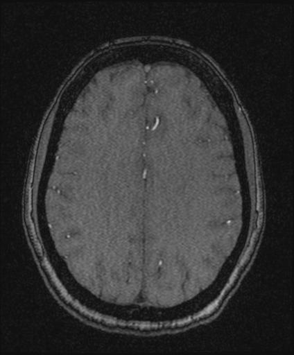 Bilateral carotid body tumors and right glomus jugulare tumor (Radiopaedia 20024-20060 Axial MRA 126).jpg