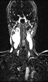 Bilateral carotid body tumors and right glomus jugulare tumor (Radiopaedia 20024-20060 MRA 101).jpg