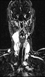 Bilateral carotid body tumors and right glomus jugulare tumor (Radiopaedia 20024-20060 MRA 92).jpg
