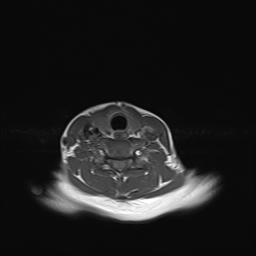 File:Bilateral carotid body tumors and right jugular paraganglioma (Radiopaedia 20024-20060 Axial 10).jpg