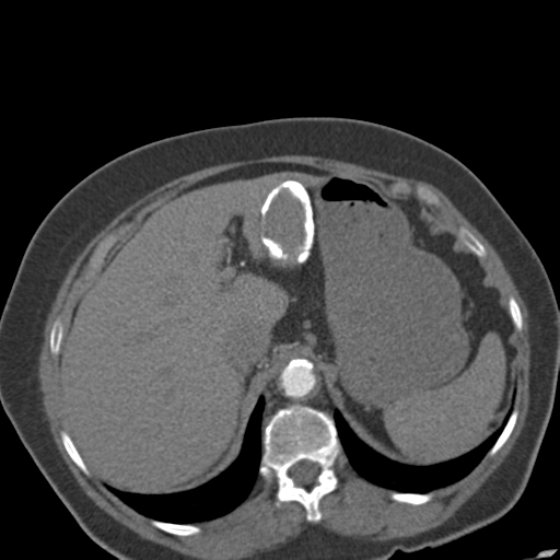 Bilateral delayed nephrogram from renal artery stenosis (Radiopaedia 47681-52362 A 13).png