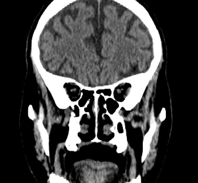 Bilateral ectopia lentis (Radiopaedia 89889-107013 Coronal non-contrast 89).jpg