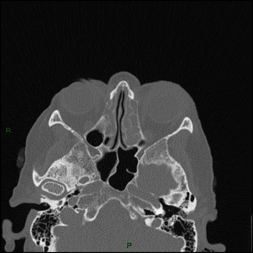 Bilateral frontal mucoceles (Radiopaedia 82352-96454 Axial bone window 156).jpg