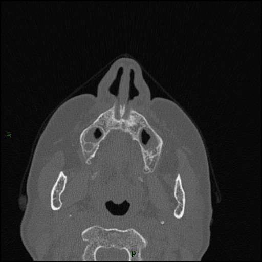 Bilateral frontal mucoceles (Radiopaedia 82352-96454 Axial bone window 232).jpg