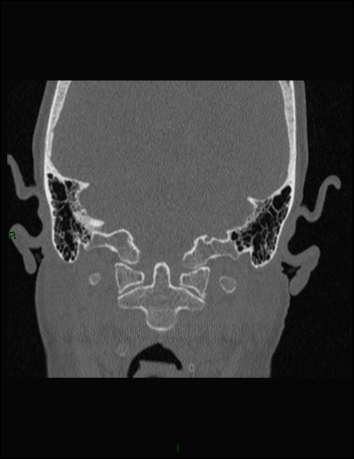 Bilateral frontal mucoceles (Radiopaedia 82352-96454 Coronal 344).jpg