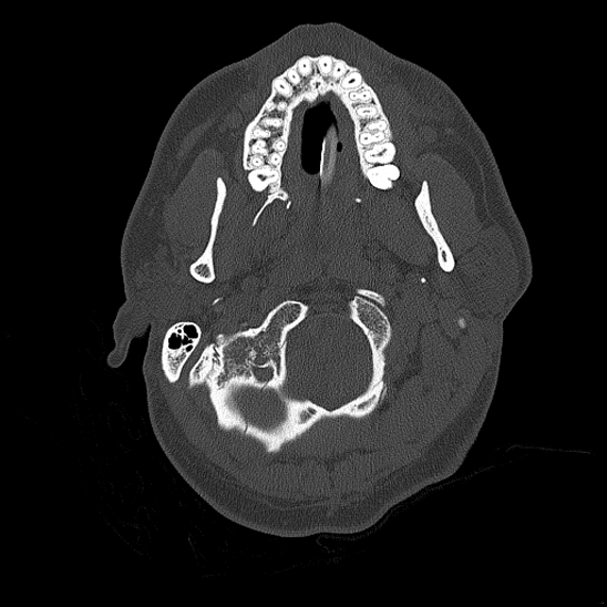 Bilateral occipital condyle fracture (type 2) (Radiopaedia 87675-104089 Axial bone thins 14).jpg