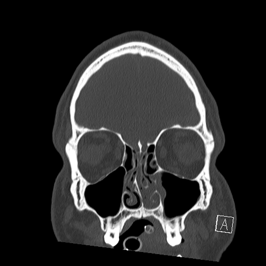 File:Bilateral occipital condyle fracture (type 2) (Radiopaedia 87675-104089 Coronal bone window 11).jpg
