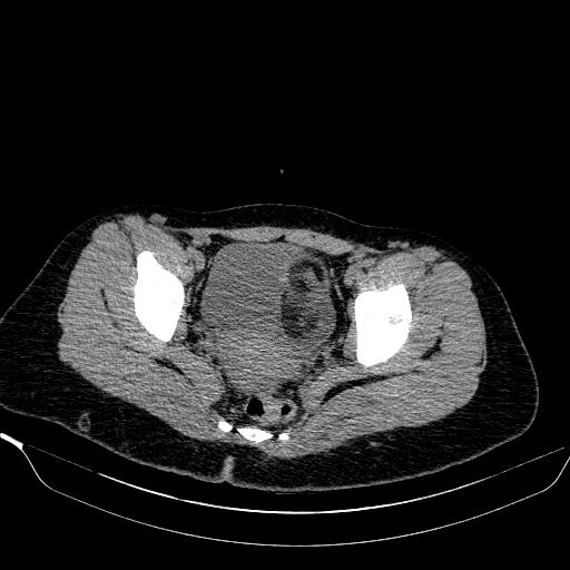 File:Bilateral ovarian dermoid (Radiopaedia 45714-49907 Axial non-contrast 32).JPEG
