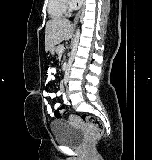 Bilateral ovarian dermoid cysts (Radiopaedia 85785-101603 D 46).jpg