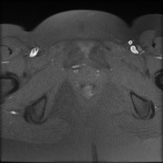 File:Bilateral ovarian fibrothecomas - adolescent (Radiopaedia 86604-102707 Axial T1 fat sat 28).jpg