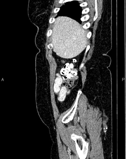 Bilateral ovarian serous cystadenocarcinoma (Radiopaedia 86062-101989 E 8).jpg