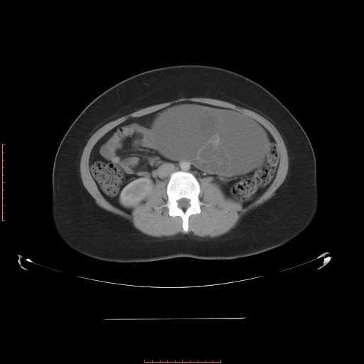 File:Bilateral ovarian serous cystadenocarcinoma with right ovarian torsion (Radiopaedia 32640-33611 A 21).jpg