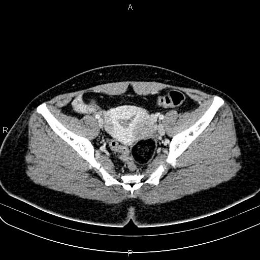 Bilateral ovarian teratoma (Radiopaedia 83131-97503 Axial With contrast 39).jpg