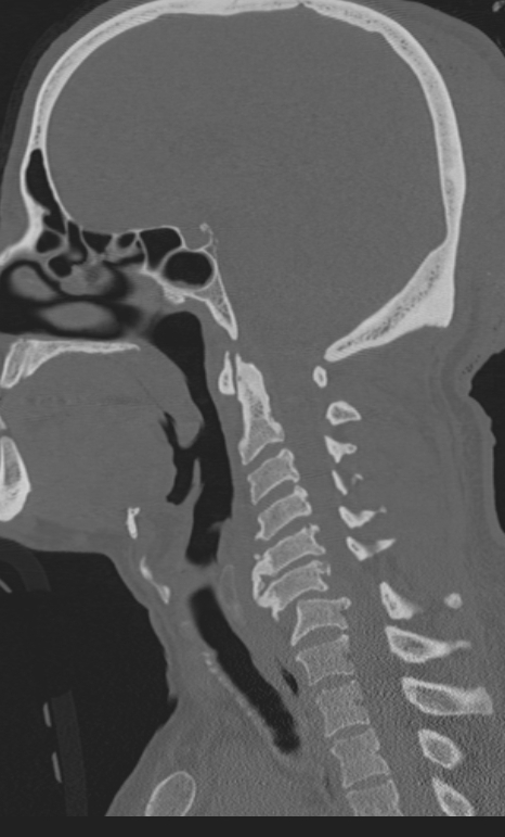 Bilateral perched facet joint (Radiopaedia 63149-71669 Sagittal bone window 28).jpg