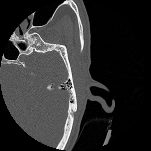 Bilateral temporal bone fractures (Radiopaedia 29482-29970 D 106).jpg