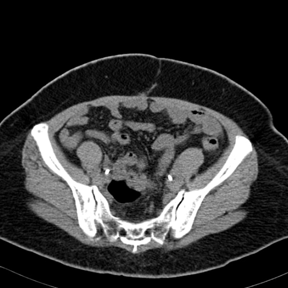 File:Bilateral ureteric stents (Radiopaedia 48795-53825 Axial non-contrast 49).jpg