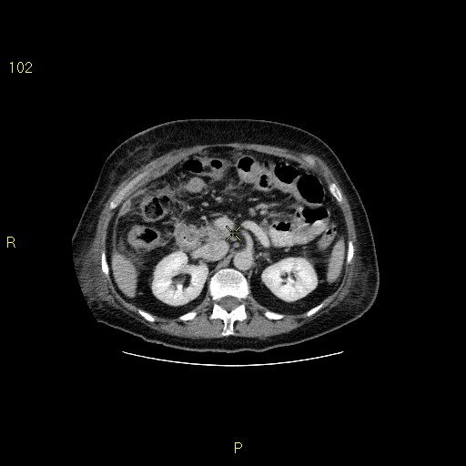 File:Biloma with drainage into the colon (Radiopaedia 20032-20068 A 3).jpg