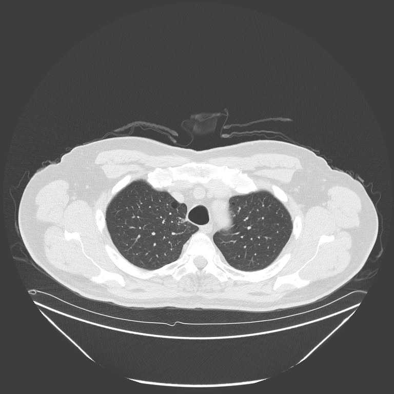 Birt-Hogg-Dubé syndrome (Radiopaedia 52578-58491 Axial lung window 12).jpg
