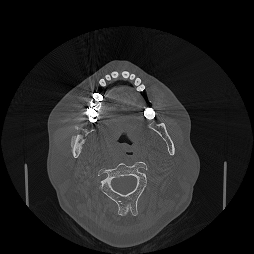 File:Bisphosphonate-related osteonecrosis of the jaw (Radiopaedia 71324-81642 Axial bone window 82).jpg