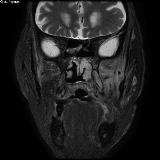 File:Bisphosphonate-related osteonecrosis of the maxilla (Radiopaedia 51367-57101 Coronal T2 fat sat 15).jpg