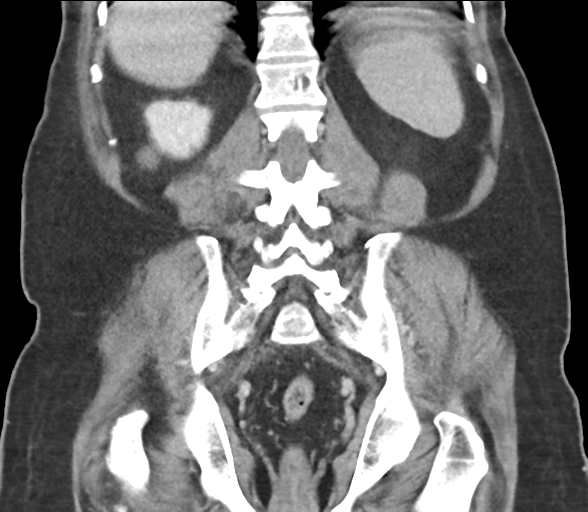 Bladder papillary urothelial carcinoma (Radiopaedia 48119-52951 C 49).png