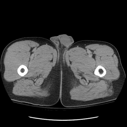 File:Blunt abdominal trauma with solid organ and musculoskelatal injury with active extravasation (Radiopaedia 68364-77895 Axial C+ delayed 160).jpg