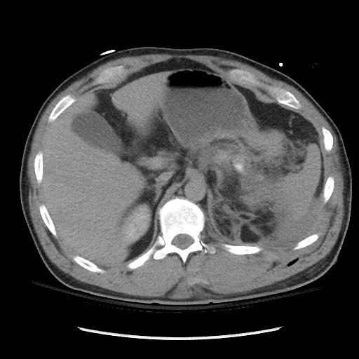 Blunt abdominal trauma with solid organ and musculoskelatal injury with active extravasation (Radiopaedia 68364-77895 Axial C+ delayed 36).jpg