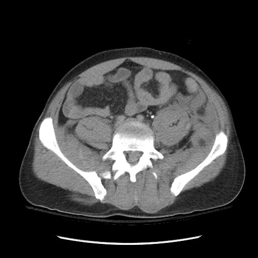 Blunt abdominal trauma with solid organ and musculoskelatal injury with active extravasation (Radiopaedia 68364-77895 Axial C+ delayed 97).jpg