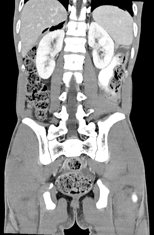 Blunt injury to the small bowel (Radiopaedia 74953-85987 B 70).jpg