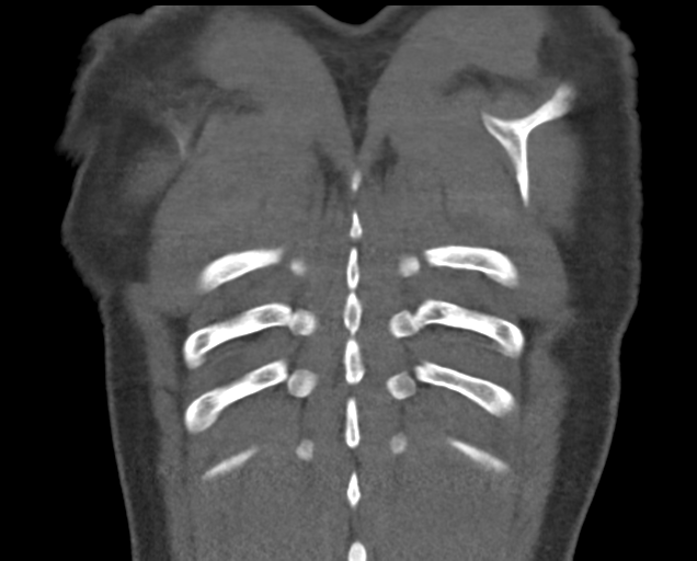 File:Boerhaave syndrome (Radiopaedia 39382-41660 C 83).png