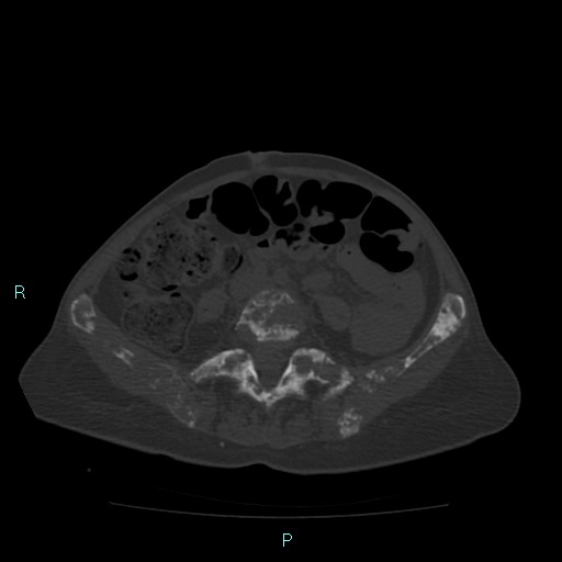 Bone metastases from untreated breast cancer (Radiopaedia 42973-46219 Axial bone window 140).jpg