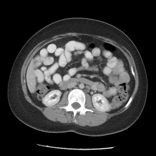 File:Borderline mucinous tumor (ovary) (Radiopaedia 78228-90808 A 87).jpg
