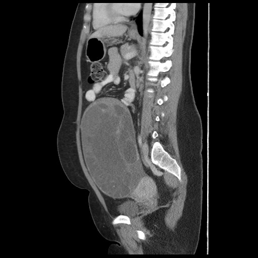 File:Borderline mucinous tumor (ovary) (Radiopaedia 78228-90808 B 40).jpg