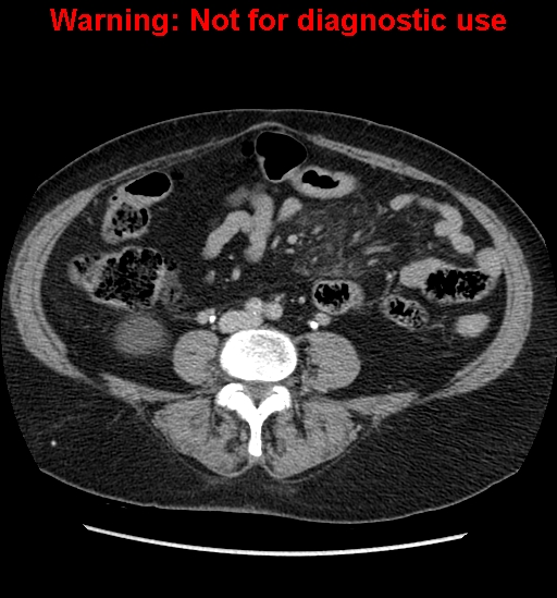 File:Bosniak renal cyst - type II (Radiopaedia 23404-23468 F 37).jpg