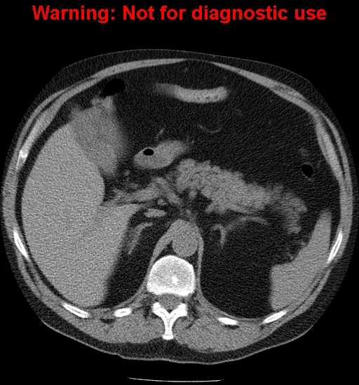 File:Bosniak renal cyst - type IV (Radiopaedia 23402-23466 Axial non-contrast 4).jpg