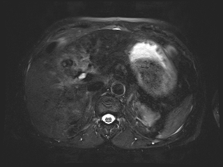 File:Bouveret syndrome (Radiopaedia 61017-68856 Axial MRCP 18).jpg