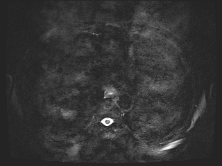 Bouveret syndrome (Radiopaedia 61017-68856 Axial MRCP 3).jpg