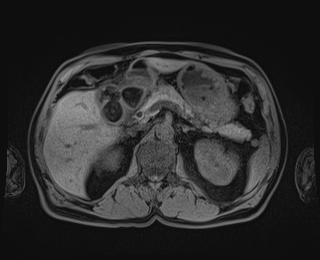 Bouveret syndrome (Radiopaedia 61017-68856 Axial T1 fat sat 31).jpg