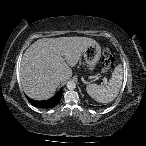 Bovine aortic arch - right internal mammary vein drains into the superior vena cava (Radiopaedia 63296-71875 A 158).jpg
