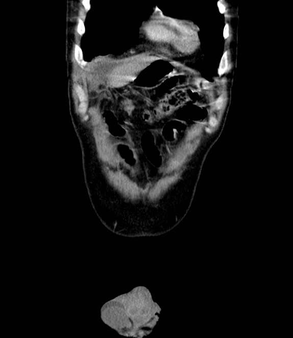 Bowel obstruction from colon carcinoma (Radiopaedia 22995-23028 C 8).jpg
