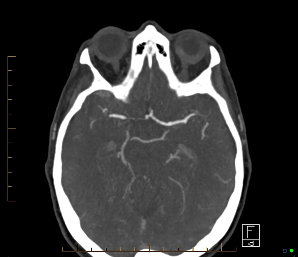 Brachiocephalic trunk stenosis (Radiopaedia 87242-103519 A 41).jpg